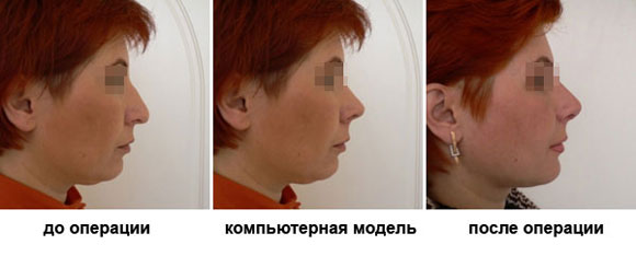 моделирование ринопластика