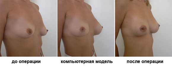 Фотомоделирование пластика груди